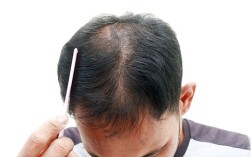 头发掉的太严重怎么解决，治掉头发的方法